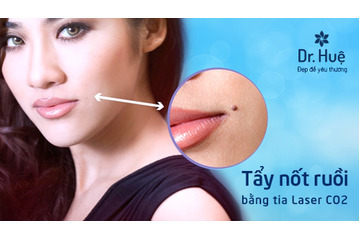 Xóa nốt ruồi bao nhiêu tiền bằng tia Laser tại Dr. Huệ
