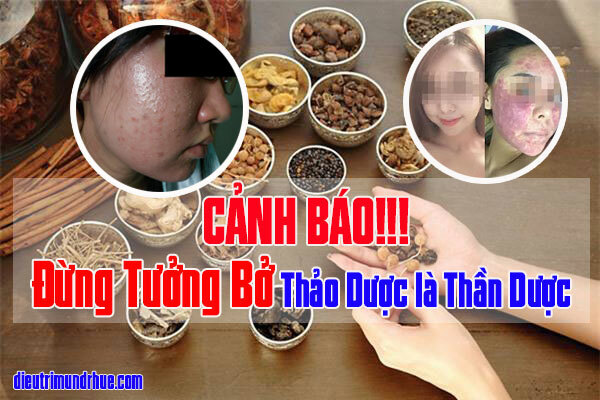 Thảo dược có phải “Thần Dược” để trị mụn hay không?