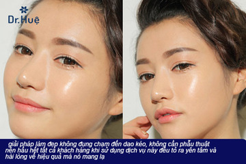 Tiêm căng bóng da mặt có tốt không có hại không