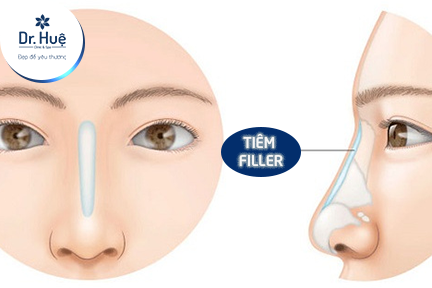 Tiêm filler bao lâu thì ổn định