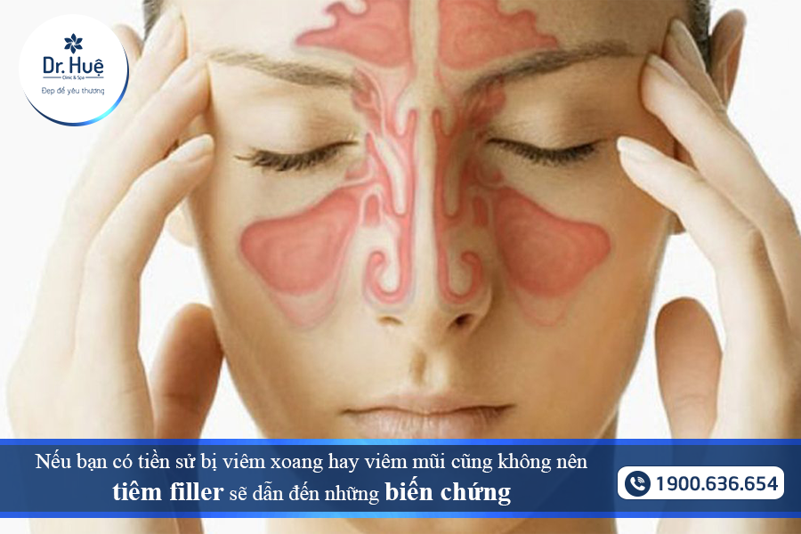 Viêm xoang không nên tiêm filler