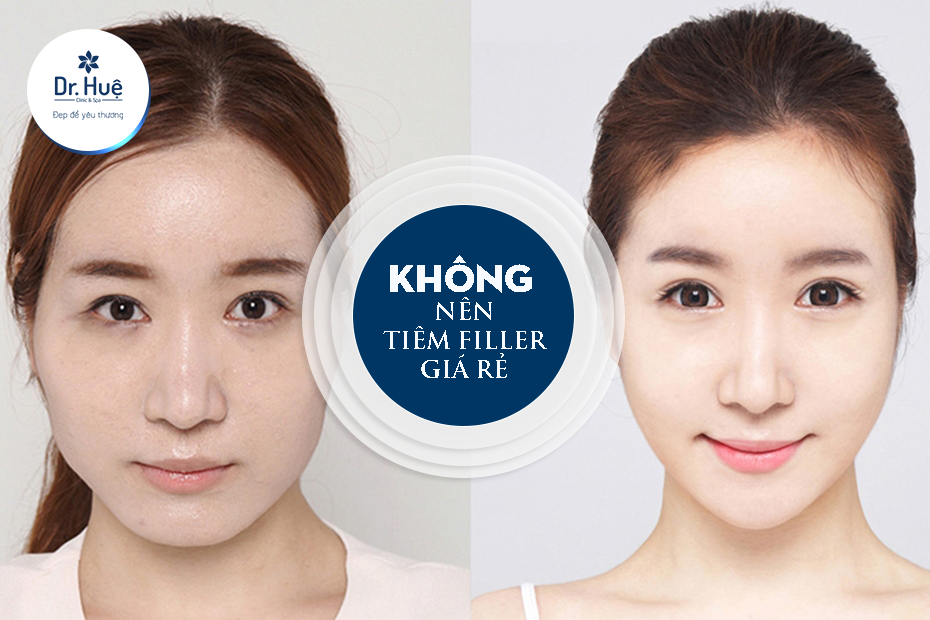 Tiêm filler là như thế nào - Có công dụng gi, nguy hiểm gì không hay gây hại về sau không?