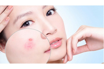 Toa thuốc trị mụn hiệu quả: Thực sự có hay không