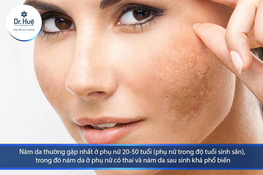 Nám da là triệu chứng thường gặp ở phụ nữ trưởng thành 