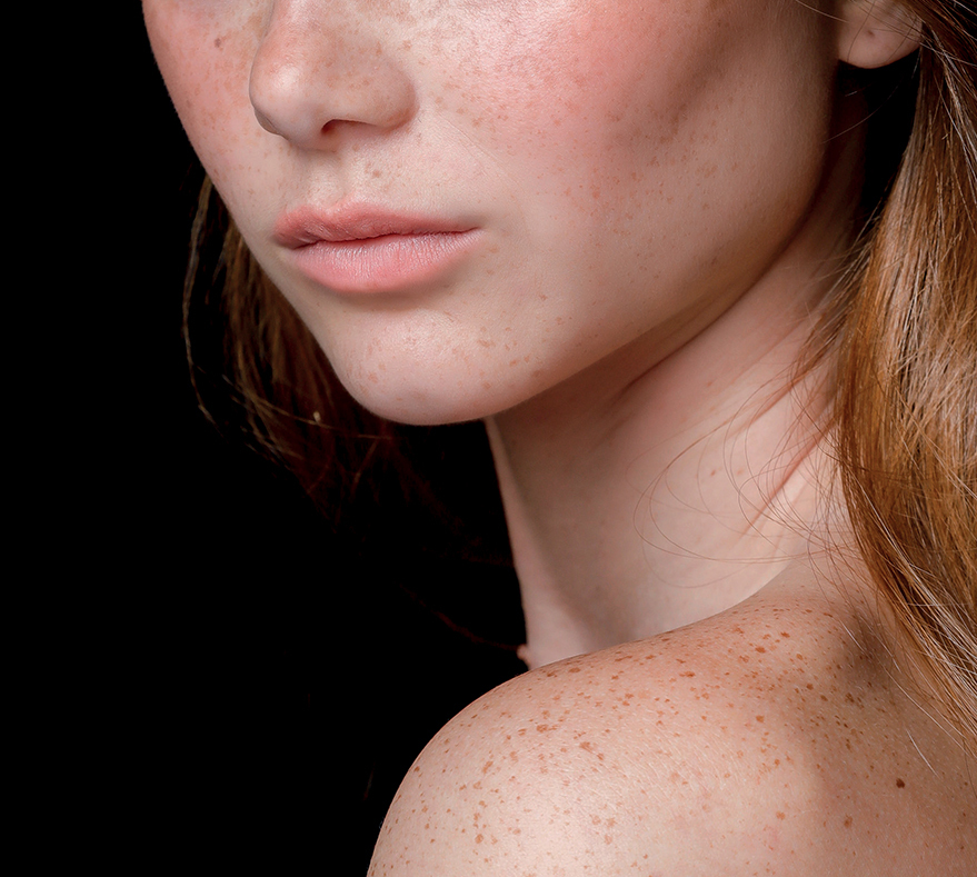 [Top] Các cách trị nám da bằng thảo dược thiên nhiên tốt nhất