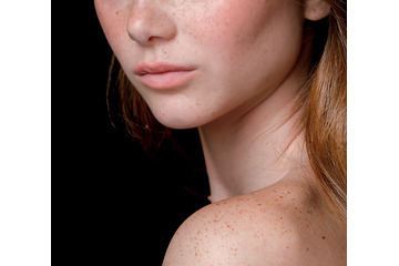 [Top] Các cách trị nám da bằng thảo dược thiên nhiên tốt nhất