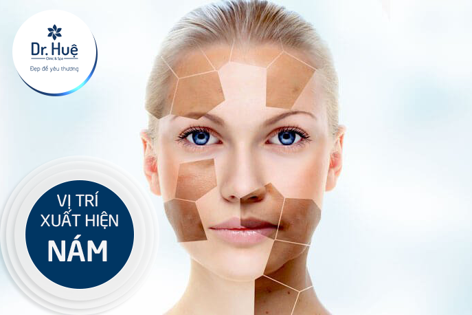 [TOP 10] cách trị nám tàn nhang từ thiên nhiên và công nghệ tốt nhất