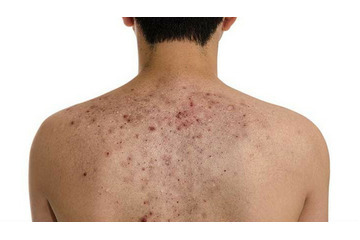 Trị dứt điểm mụn lưng ở đâu?