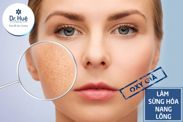 oxy già không chữa được mụn