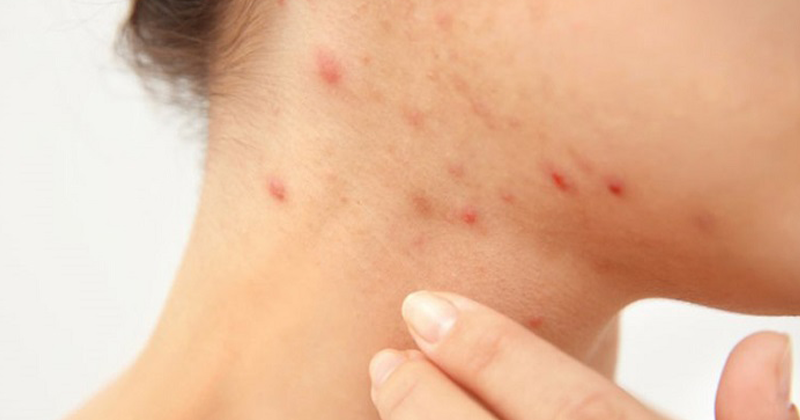 Trị mụn bằng thuốc kháng sinh có tốt không?