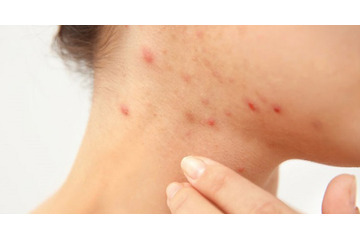 Trị mụn bằng thuốc kháng sinh có tốt không?