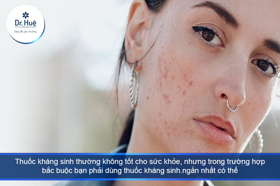 trong trường hợp mụn nặng phải dùng kháng sinh