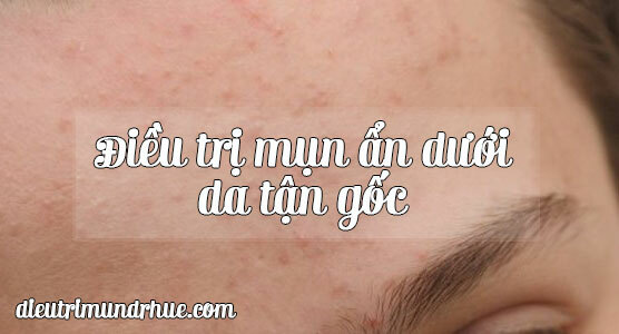 Trị mụn ẩn tận gốc bằng cách nào?