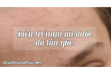 Trị mụn ẩn tận gốc bằng cách nào?