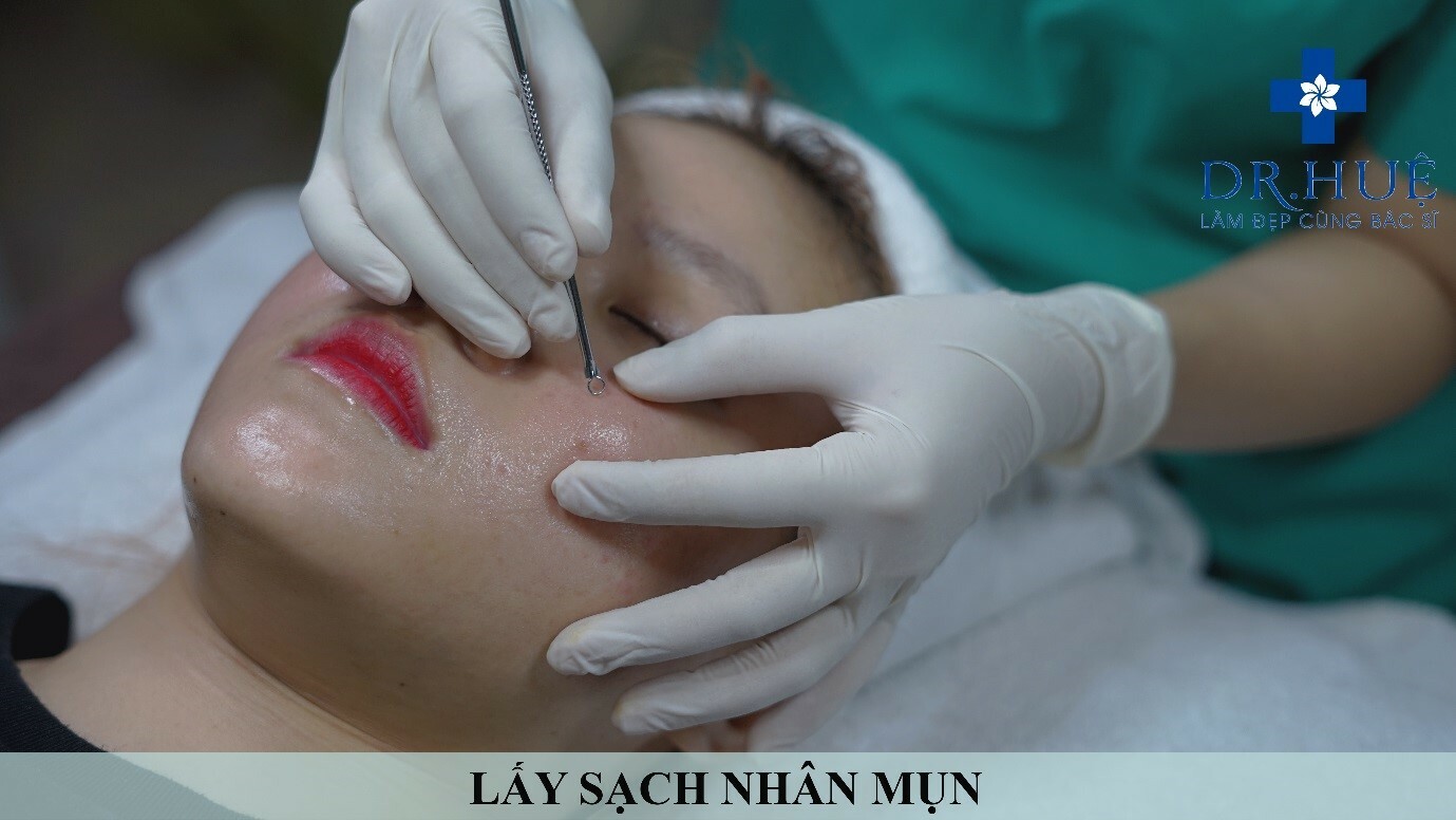 Trị mụn Trị sẹo ngay để kịp ăn Tết
