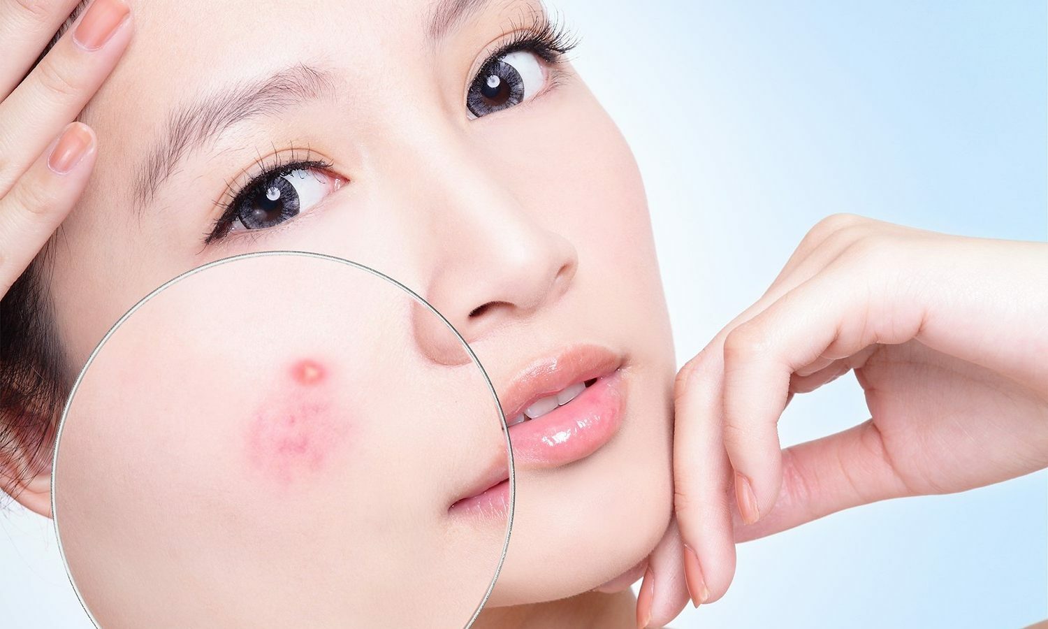 Trị mụn xưa và nay, cách nào hiệu quả hơn?