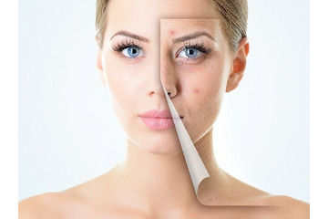 Trị thâm hoàn toàn bằng Nano Basic