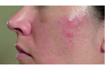 Truy tìm loại mụn đáng sợ nhất?