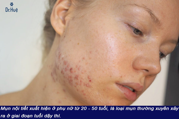 [Tư Vấn] Bị mụn nội tiết tố nên uống thuốc gì?