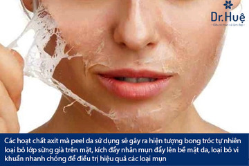 [Tư Vấn] Có Nên Peed Da Thay Da Sinh Học Trị Mụn Không