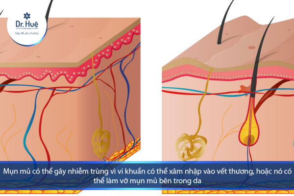 [Tư Vấn] Da mặt bị ngứa và nổi mụn mủ nên làm gì