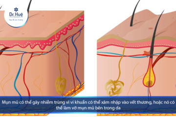 [Tư Vấn] Da mặt bị ngứa và nổi mụn mủ nên làm gì