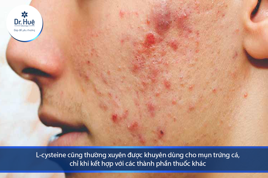 L-cysteine cũng thường xuyên được khuyên dùng cho mụn trứng cá