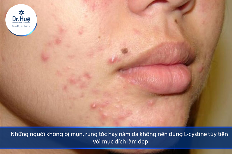 Mụn sẽ đến từ nhiều nguyên nhân khách quan và chủ quan, chứ không phải vì một yếu tố riêng biệt như uống L-cystine