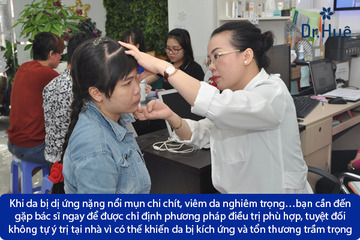 [Tư Vấn] Bị nổi mụn do dị ứng kem Pond's phải làm sao