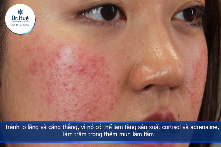 tránh lo lắng nhiều làm nổi mụn 