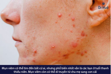 [Tư Vấn] Mụn bị viêm có nên nặn không và nên làm gì