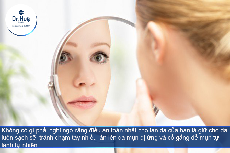 Không nên nặn mụn 