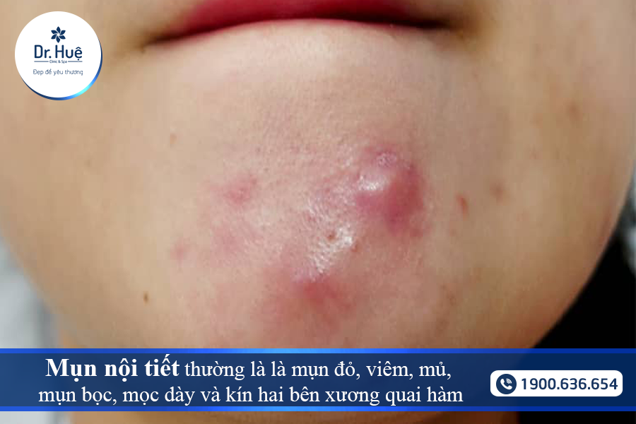 mụn mọc kín hai bên xương quai hàm, nhiều lúc sẽ lan xuống cổ. 