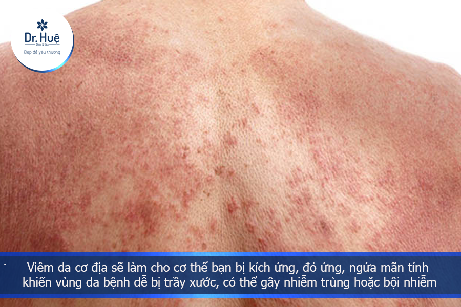 Viêm da cơ địa sẽ làm cho cơ thể bạn bị kích ứng, đỏ ứng, ngứa mãn tính 