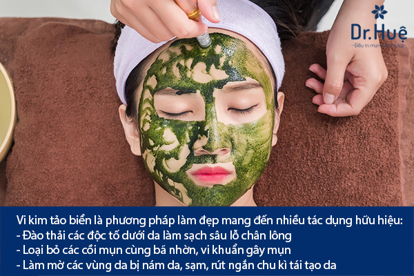 Vi Kim Tảo Biển Có Trị Mụn Được Không