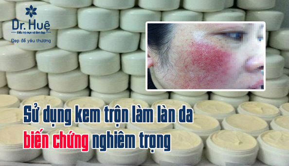 Vì sao sử dụng kem trộn làm làn da biến chứng nghiêm trọng