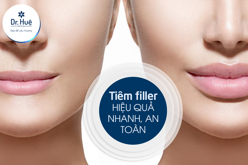 Vì sao tiêm Filler bị tràn và nên làm gì?