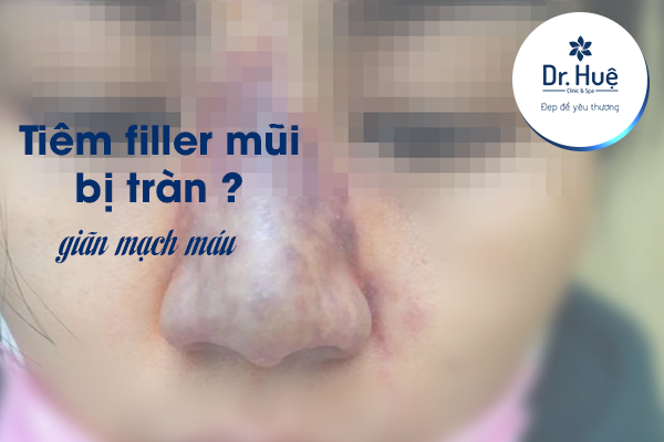 Tiêm filler mũi bị tràn 