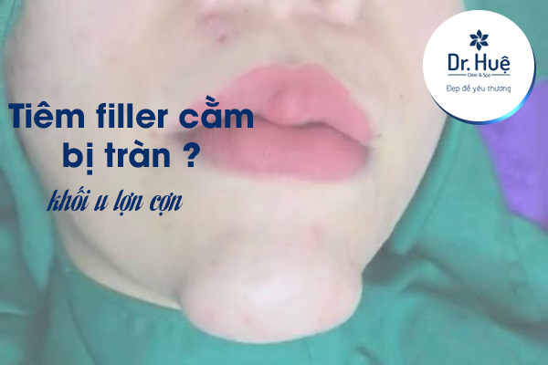 Tiêm filler cằm bị tràn 