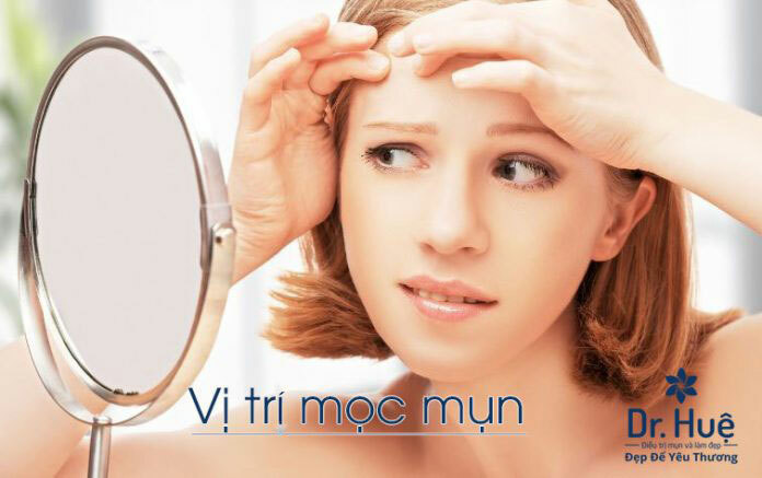 Vị trí mụn mọc trên cơ thể tiết lộ điều gì?