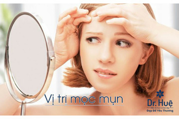 Vị trí mụn mọc trên cơ thể tiết lộ điều gì?