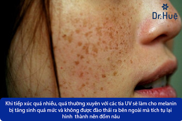 Trên da có đám đổi màu nâu xuất hiện đốm đen là bị gì